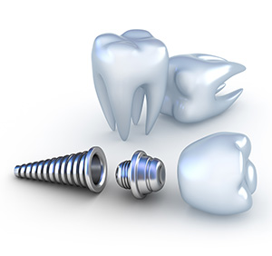 dental implant